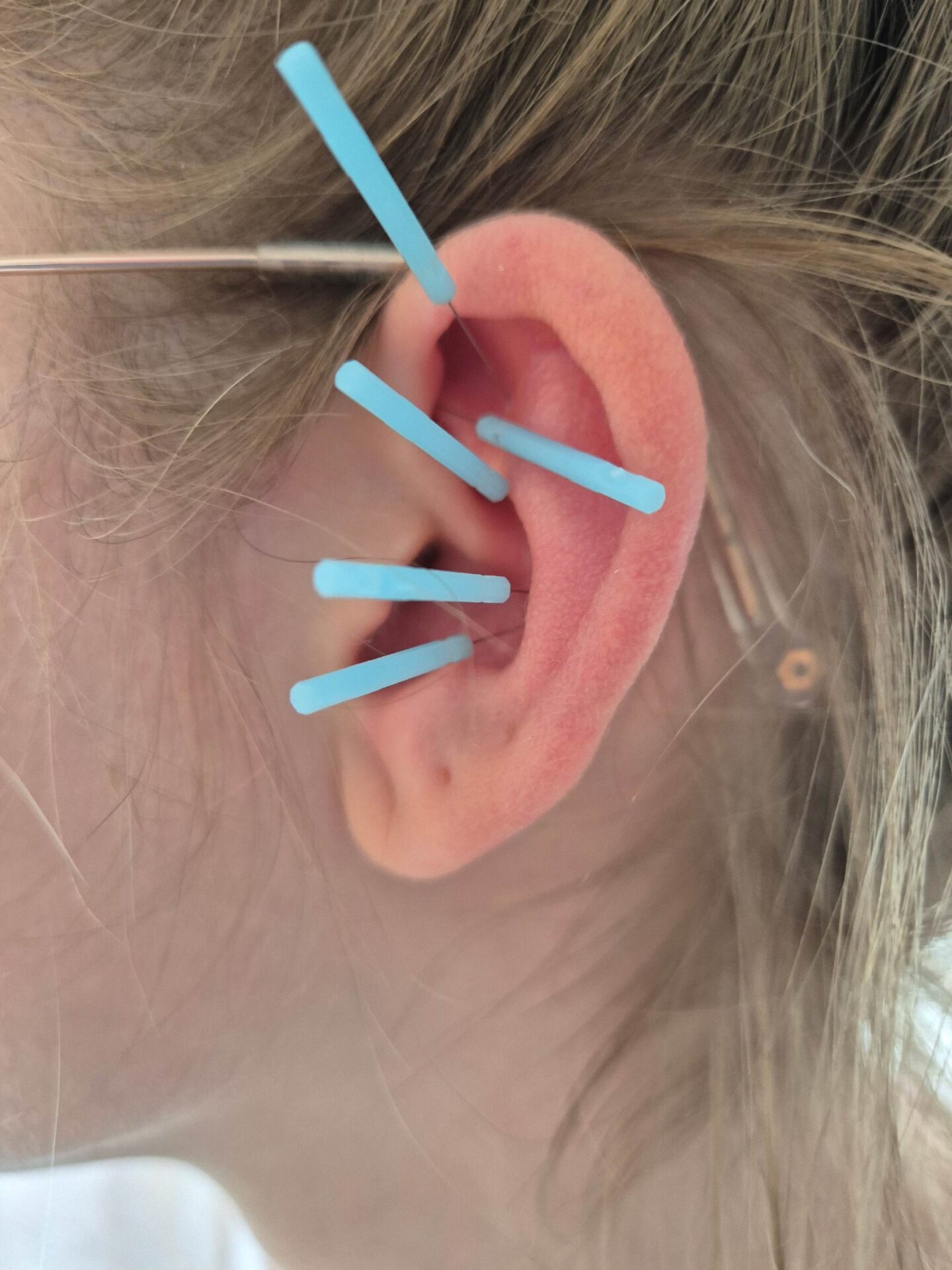 NADA-Therapie bei OptimaMed in Wildbad