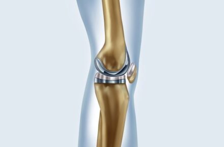 Gut vorbereitet in die Knie- oder Hüftoperation